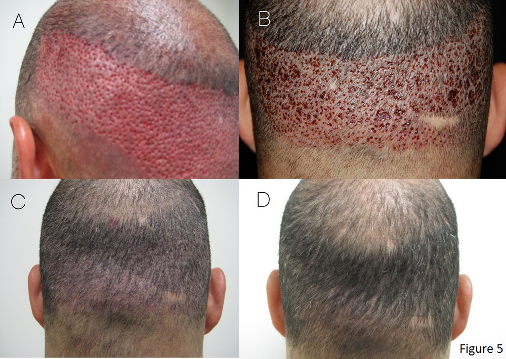 can you regrow hair after hair loss